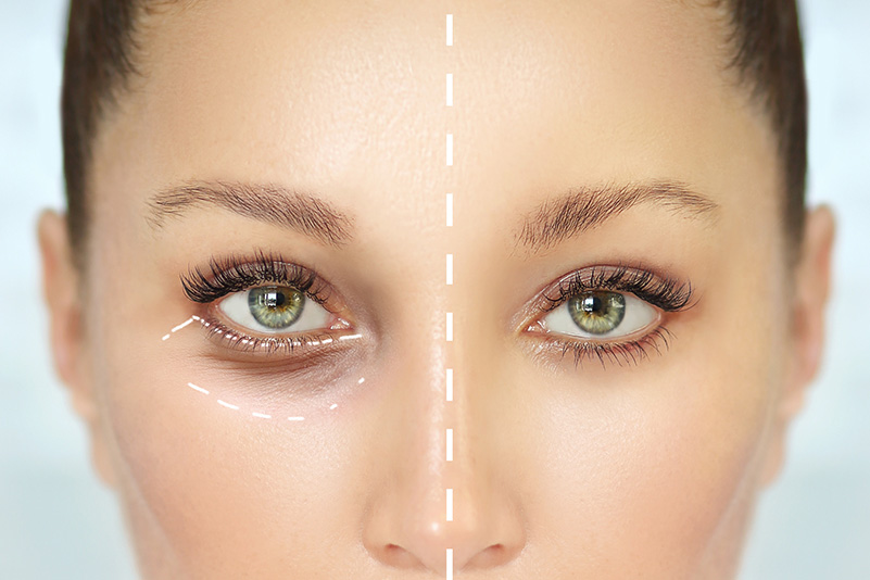 before and after Blepharoplasty