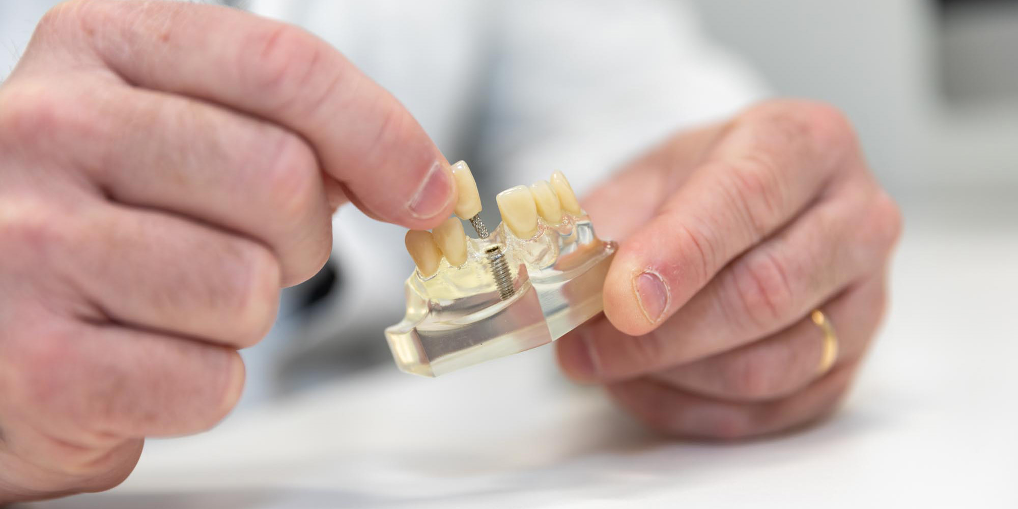 dental implant model