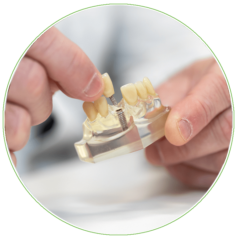 dental implants model