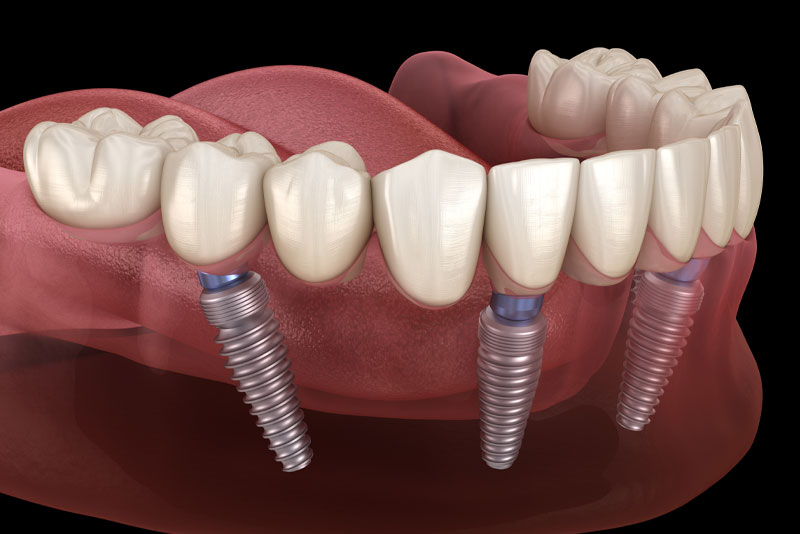 full mouth dental implants model