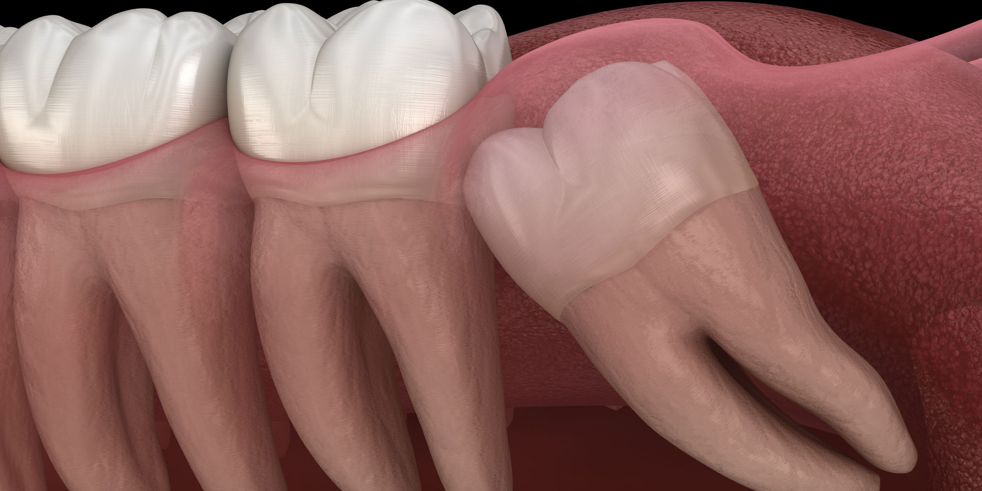 impacted wisdom teeth graphic