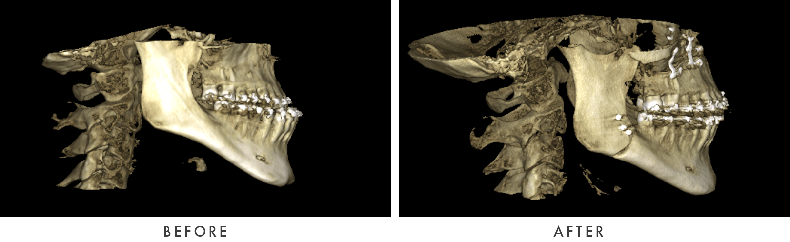 Orthognathic Case