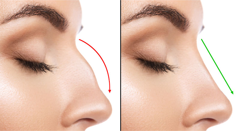 rhinoplasty before and after