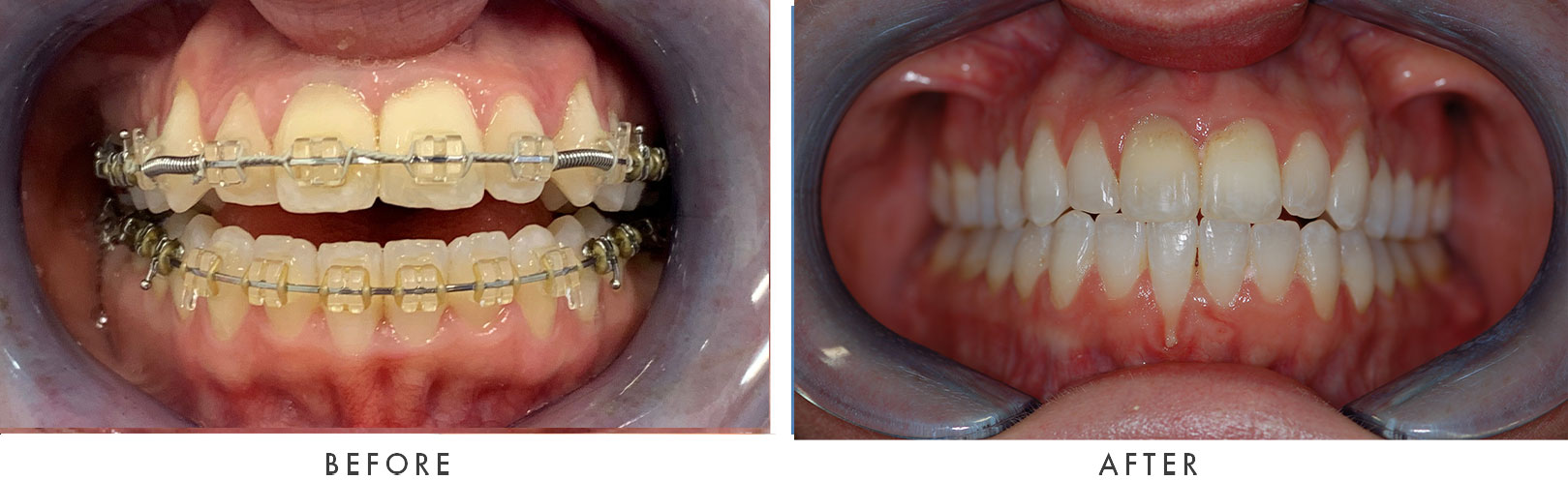 Orthognathic Case